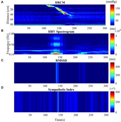 Optimizing Autonomic Function Analysis via Heart Rate Variability Associated With Motor Activity of the Human Colon